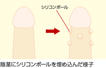 シリコンボール 陰茎増大術 四日市の美容整形リベールクリニック